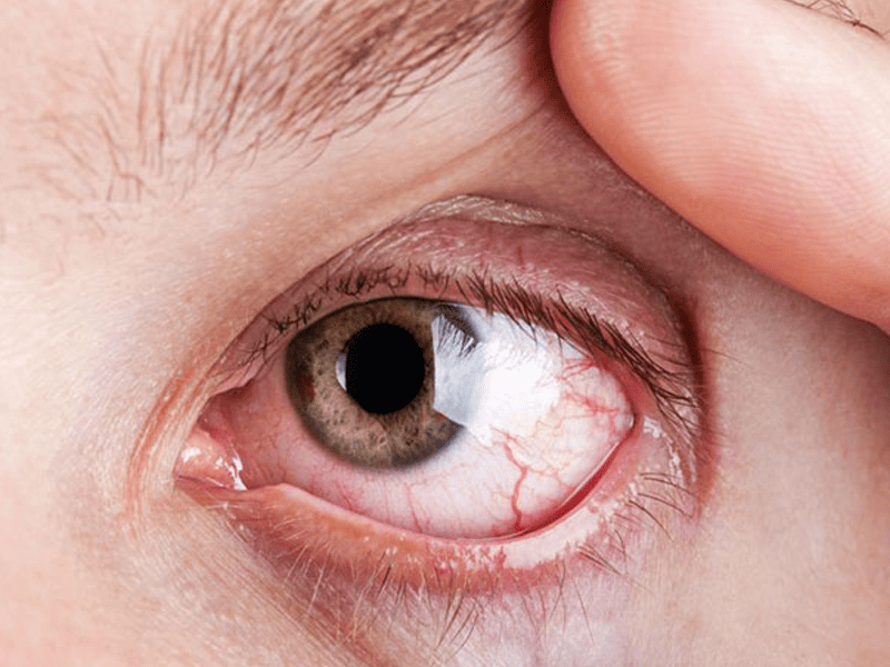 diyabetik-goz-tutulumu-retinopati