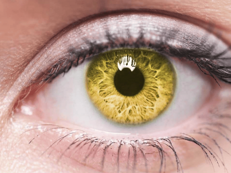 sari-nokta-hastaligi-makula-dejenerasyonu