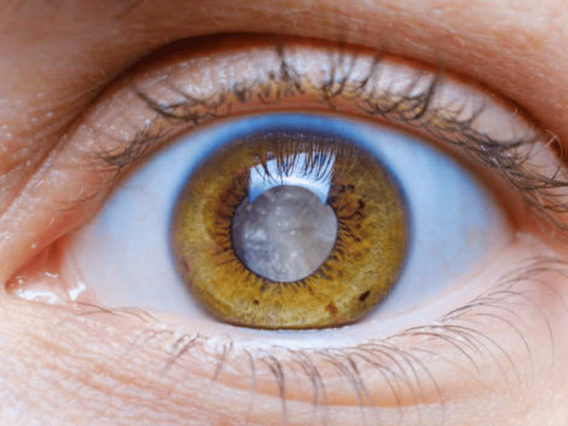 glokom-goz-tansiyonu